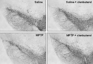 贝赛特氏症发病的照片,透过影像揭示的罕见疾病面纱